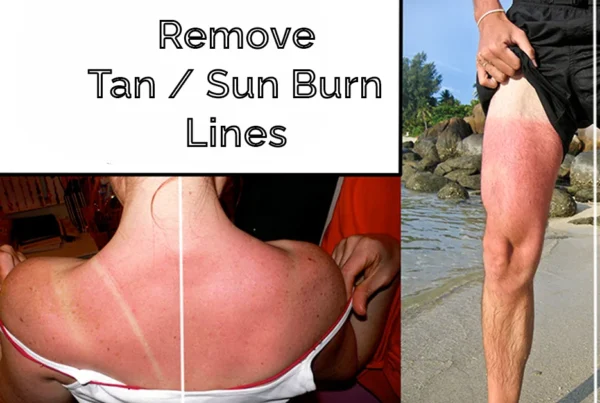 Photoshop tutorial thumbnail featuring the text "Remove Tan Lines" over a close-up of a skin retouching process on a back and shoulder area.
